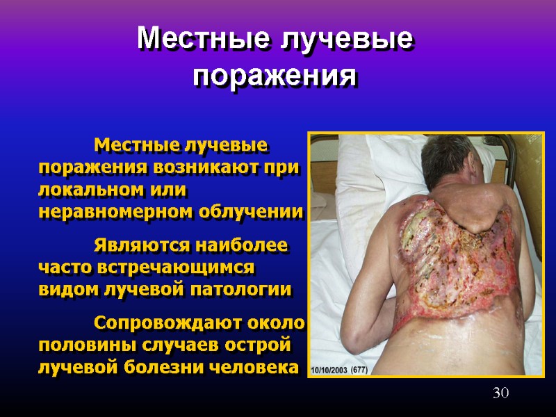 30 Местные лучевые поражения  Местные лучевые поражения возникают при локальном или неравномерном облучении